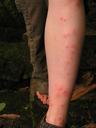 Ashe, showing off just a small fraction of the 200+ bed bug bites she endured the previous night in our classy guesthouse in Champasak. Bed bugs are just one of the many uncomfortable realities of travel through South East Asia.